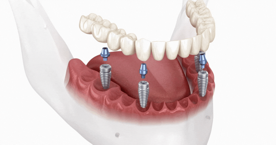 Implant overdenture solution