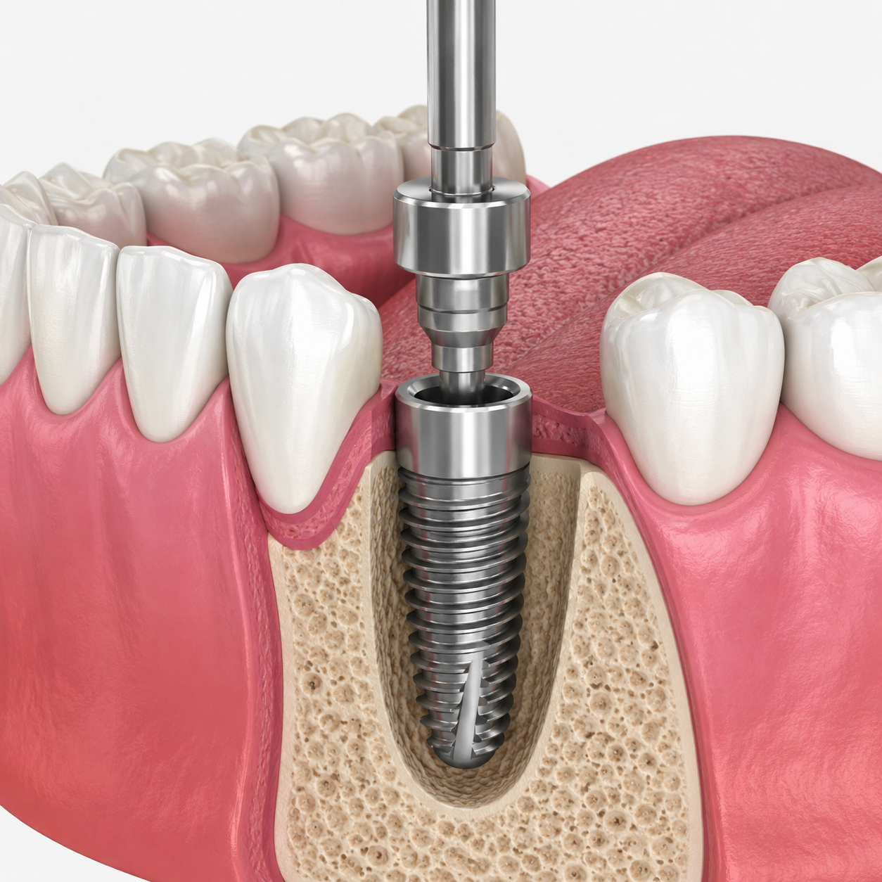 Implant placement