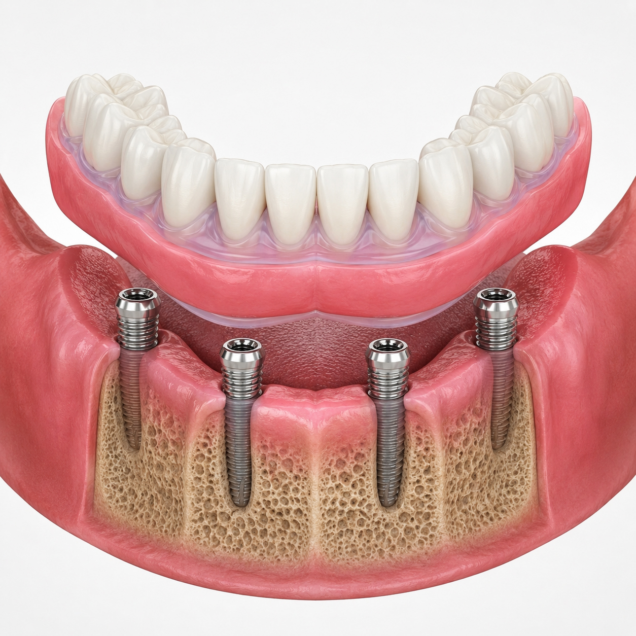 Implant denture healing process