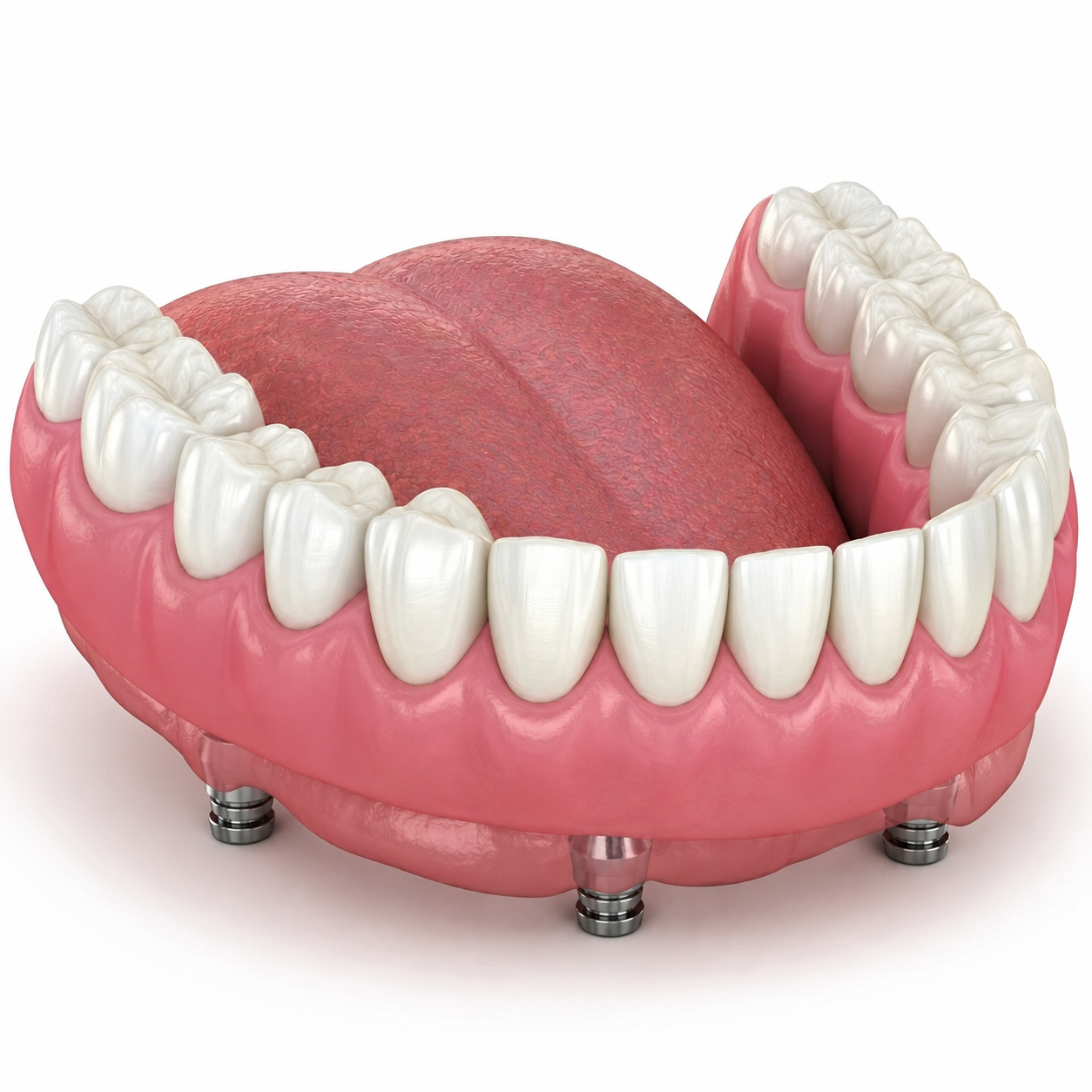 Final snap-on denture fitting